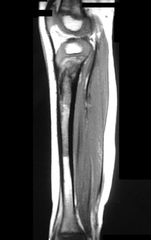 Figura 9: RM sag T1, com lesão meta-diafisária na tíbia.