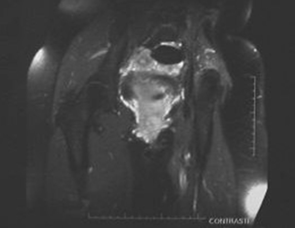 Figura 65: RM coronal T1 Spir, com contraste, após dois anos da cirurgia, bom aspecto, sem recidiva.