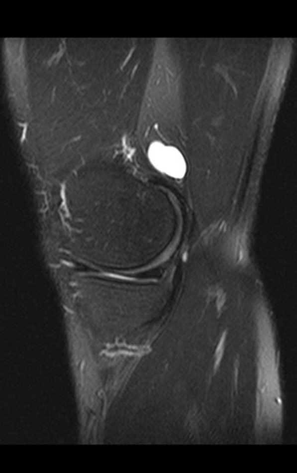 Figura 5: Ressonância magnética realizada um ano antes da queixa atual. Imagem sagital, ponderada em T1, com supressão de gordura, evidenciando lesão de alto sinal na região posterior do joelho direito.