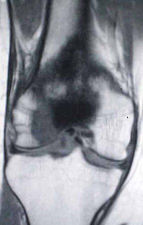 Figura 8: RM, coronal T1. O condrossarcoma atinge a epífise femoral.