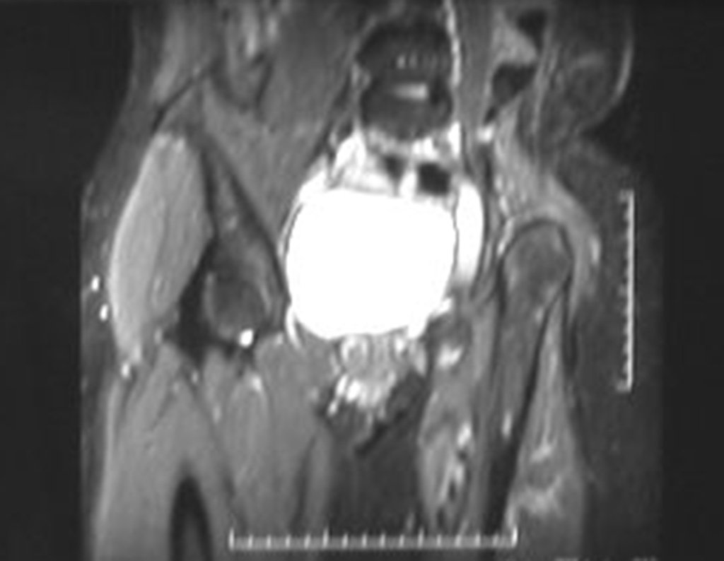 Figura 60: RM coronal T2 Stir, após dois anos da cirurgia, sem sinais de recidiva.