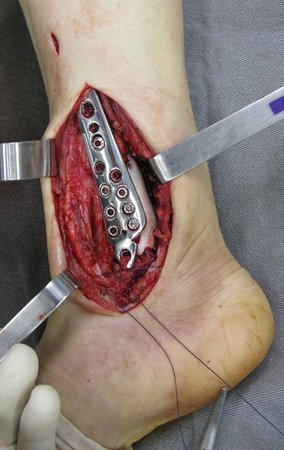 Figura 21: Início do fechamento da incisão. O tornozelo é uma articulação muito superficial e com poucos tecidos para cobertura. É importante o correto fechamento dos tecidos moles com cobertura do implante pela fáscia muscular para minimizar complicações de ferida operatória.