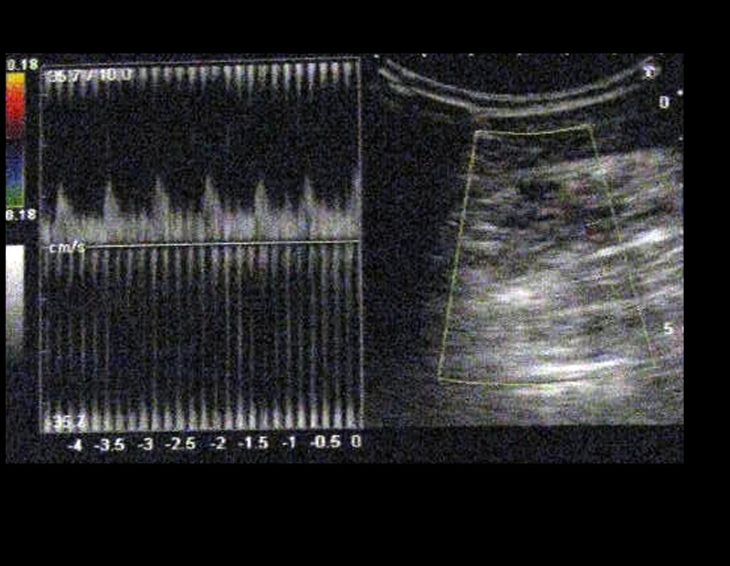 Figura 4: A lesão aparenta ser hipovascular, do ponto de vista arterial. Trata-se de provável hemangioma que é formado por lagos venosos e portanto muito vascularizado. Isso é importante quando se opta pela ressecção, pois pode levar a grandes sangramentos, quando é operada.