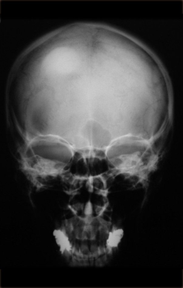 Figura 4: Radiografia do crânio com lesão nodular, densa, homogênea, na calota.