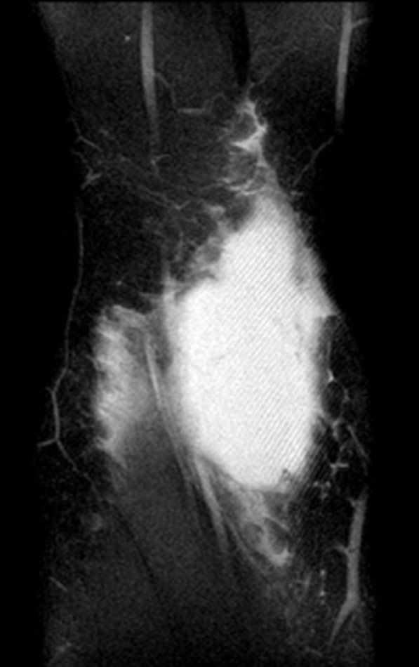 Figura 9: Ressonância magnética atual evidenciando imagem coronal, ponderada em T2, com lesão de alto sinal.