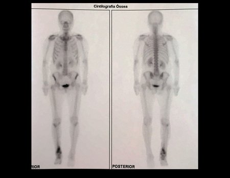 Figura 10: Cintilografia. Nesta paciente não observamos lesões em outros locais do esqueleto, além do tornozelo.