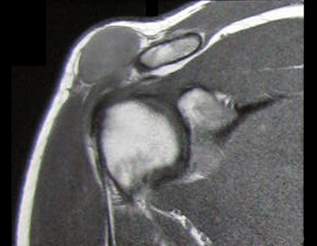 Figura 5: Rm cor, com lesão sólida superficial, com baixo sinal em T1, localizada acima do acrômio e extremidade distal da clavícula direita.