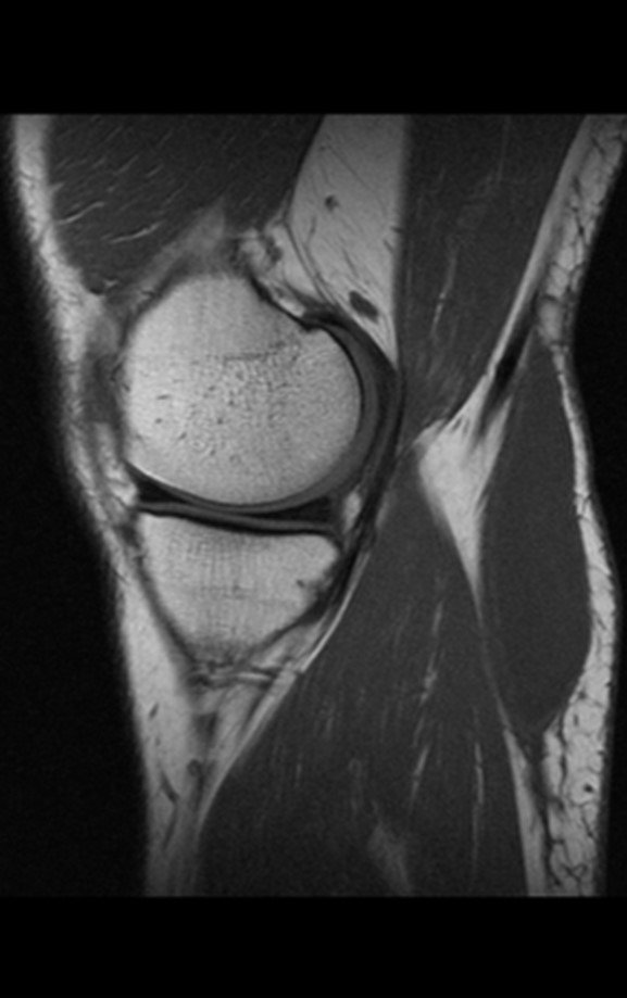 Figura 11: Ressonância magnética atual evidenciando imagem coronal ponderada em T1, com lesão de baixo sinal entre o plano celular subcutâneo e a fáscia muscular.