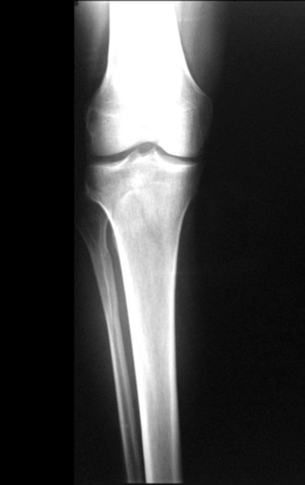 Figura 6: Radiografias do joelho direito de frente, evidenciando sequela antiga de doença de Os Good Schlatter, sem outras alterações relevantes ósseas ou de tecidos moles