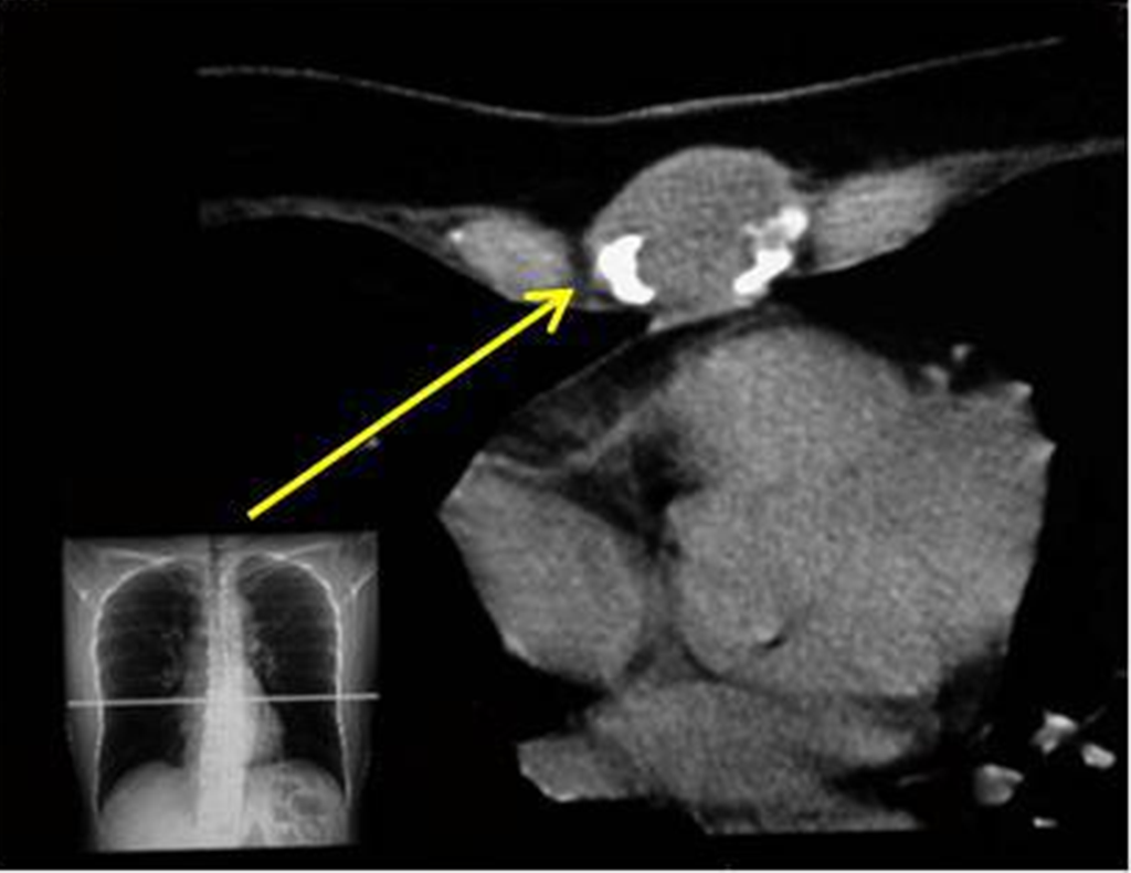 Figura 22: Tomografia de toráx, evidenciando o comprometimento do esterno, densidade para tecidos moles