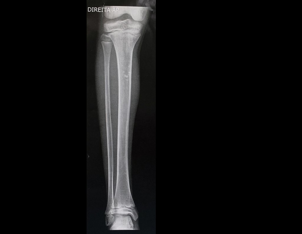 Figura 1: Radiografia da perna direita, visão de frente, evidenciando discreta calcificação no terço proximal, que aparenta ser intra-ósseo. Essa impressão desaparece quando se observa a imagem da radiografia em perfil.