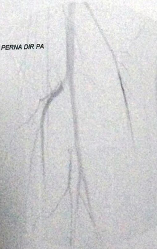 Figura 14: Arteriografia evidenciando ausência de pedículo vascular entre a lesão e o feixe arterial.