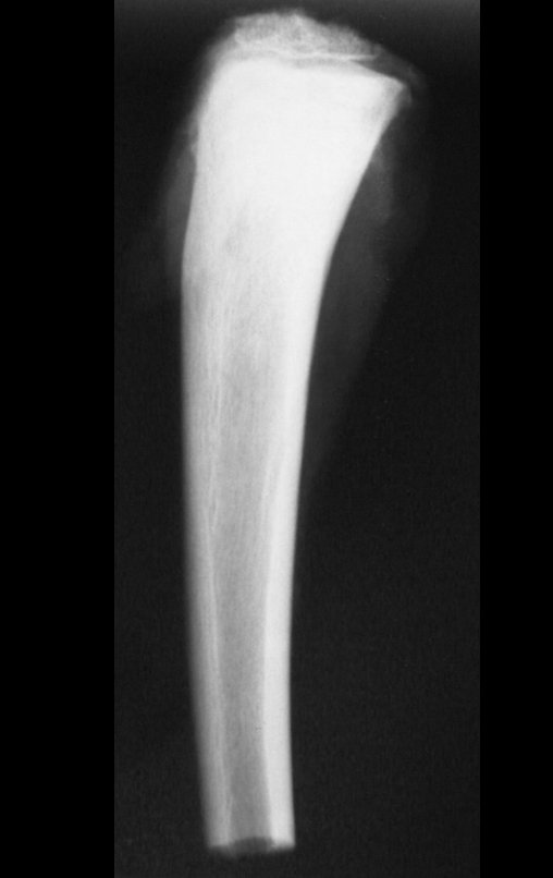 Figura 108: Radiografia do pós operatório da peça ressecada, perfil, destacando a retirada da cartilagem de crescimento.