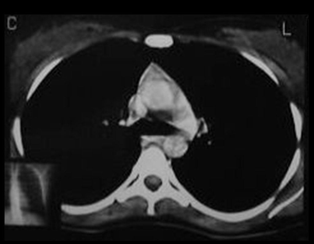 Figura 67: Tomografia do tórax normal, após três anos da cirurgia.