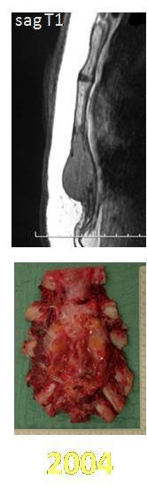 Figura 47: Peça ressecada em 2004. Figura 44: Rm axial T1 do tumor do esterno e a peça ressecada, em 2004.