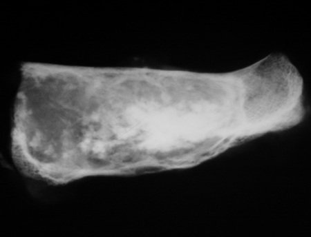 Figura 10: Radiografia da peça cirúrgica, em bloco. Observamos as áreas líticas e os focos de condensação.