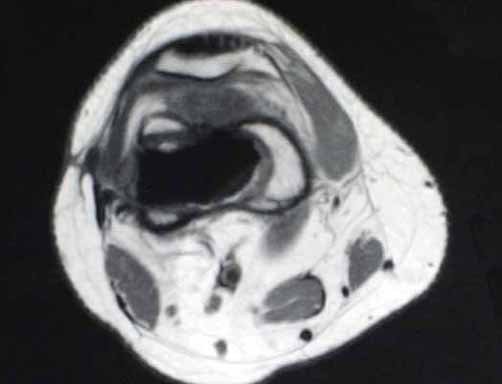 Figura 9: RM, ax T1, detalhando a permanência e progressão do tumor, com tumor extra cortical.