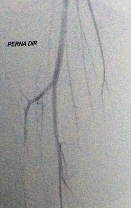 Figura 15: Nodularos calcificados na região proximal e medial da perna, com mínimo enchimento vascular através de pequenos ramos geniculares e outro proveniente a artéria tibial posterior.