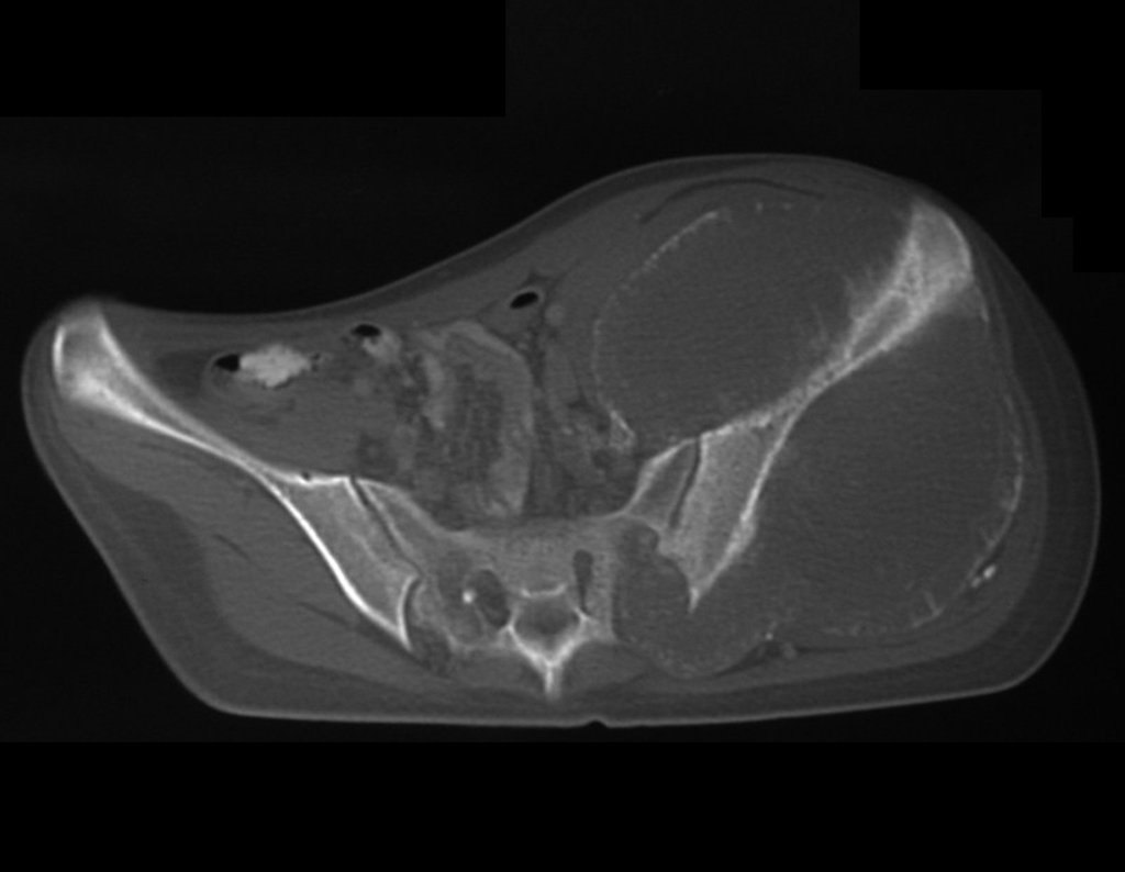 Figura 17: Tomografia axial, densidade para osso, grande tumor acometendo o ilíaco esquerdo.