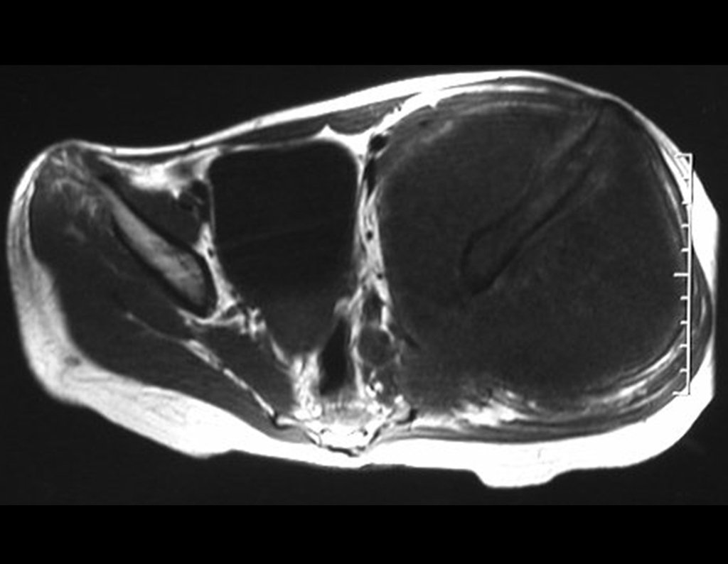 Figura 9: RM axial, com baixo sinal em T1, com grande tumor extracortical, comprometendo a tábua interna e a tábua externa do ilíaco direito.