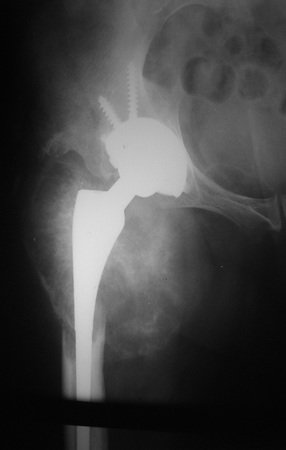 Figura 5: Radiografia da pelve direita, após alguns meses da reconstrução com prótese convencional, A recidiva do condrossarcoma é evidente.