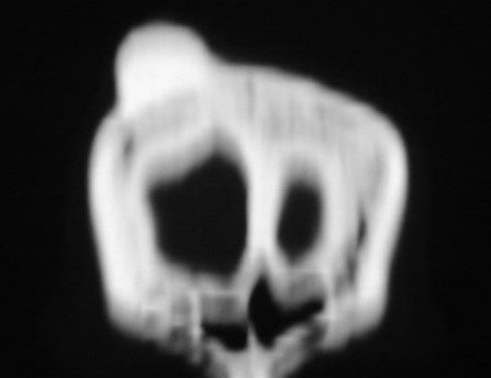 Figura 8 Tomografia com reconstrução em corte coronal, confirmando a íntima relação com a cortical externa.