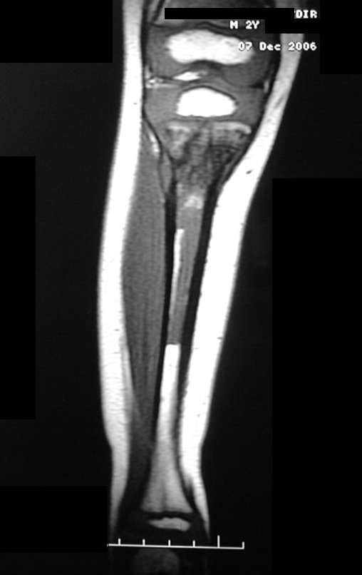Figura 8: RM cor T1, apresenta lesão na região metafisária proximal da tíbia direita, sem sinal de comprometimento da epífise.