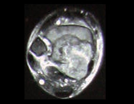 Figura 7: Rm axial T2 Spir. nesta imagem podemos situar a relação do tumor com as estruturas nobres da região. O feixe vascular tibial posterior parece estar livre da neoplasia, da mesma forma o tendão calcâneo e a articulação fíbulo talar distal.