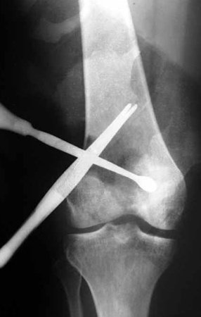 Figura 1: Radiografia do procedimento intralesional por pequena incisão!!!??? A cureta e a pinça apontam a profundidade, querendo o cirurgião inferir que por este acesso consegue atingir toda a lesão. Sabemos que isto não é correto, apenas espalha a lesão.