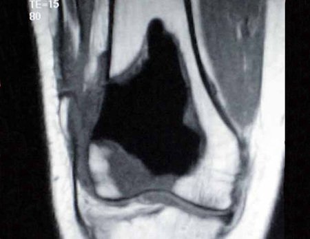 Figura 5: Ressonância magnética, em corte coronal T1, mostrando a permanência de tumor, sinal intermediário ao redor do cimento (baixo sinal). Nota-se ainda extravasamento da lesão pela abertura cirúrgica da cortical lateral e em tecidos moles.