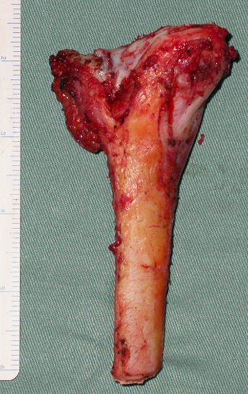 Figura 104: Peça com o trajeto da biópsia ressecado, osteotomia curvelínea, transfisária na tuberosidade tibial e transepifisária no restante.