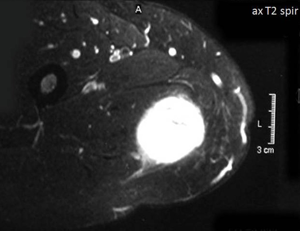 Figura 6: RM ax T1 com saturação de gordura, evidencia o vaso nutrício da lesão