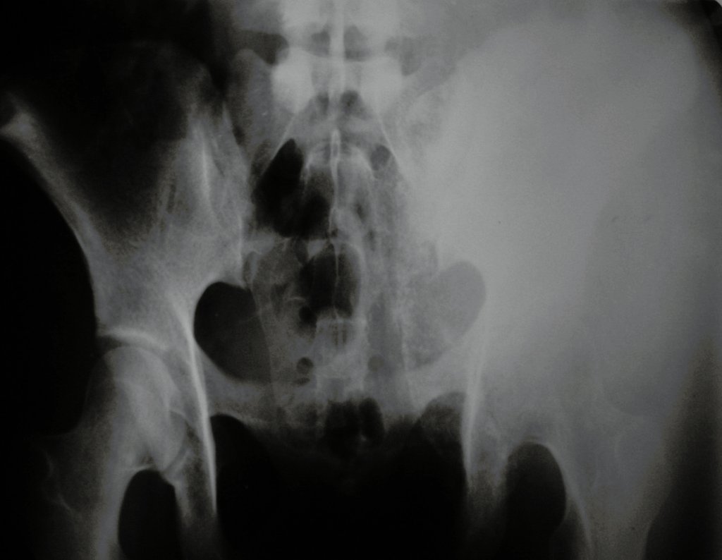 Figura 1: Radiografia de 18/12/2002, bacia frente, com lesão condensante acometendo o ilíaco esquerdo