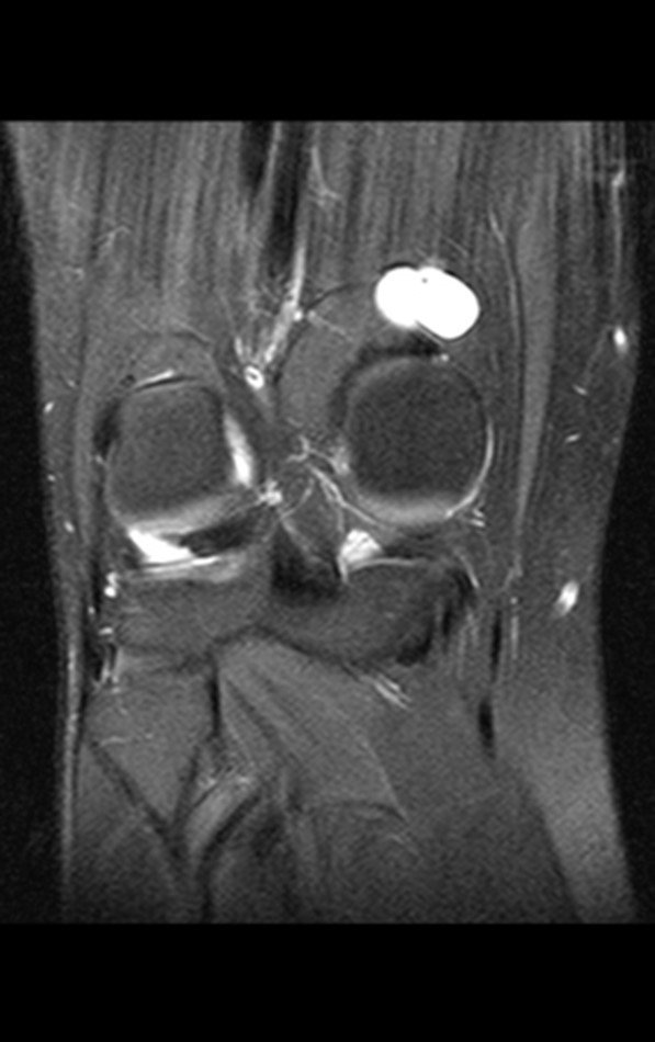 Figura 3: Ressonância magnética realizada um ano antes da queixa atual. Imagem coronal ponderada em T1, com supressão de gordura, evidenciando lesão de alto sinal na região posterior do joelho direito.