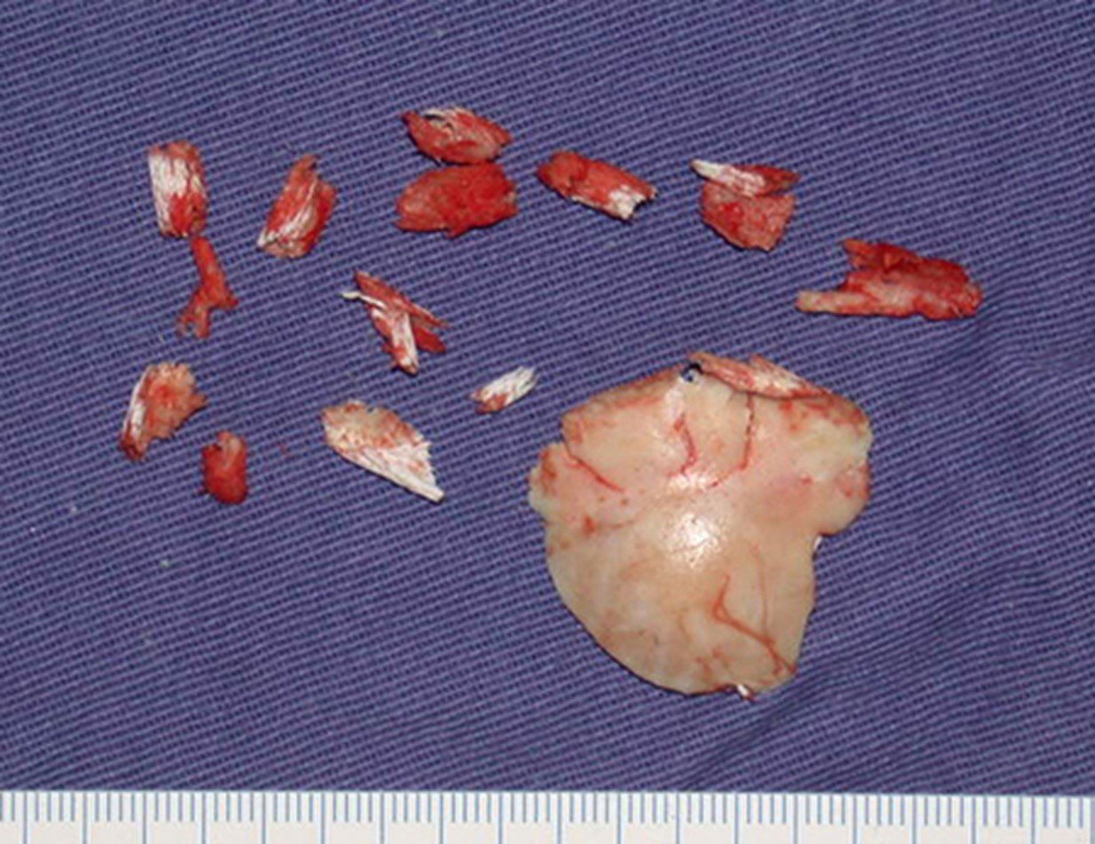 Figura 19: Fragmentos do osteoma ressecado.