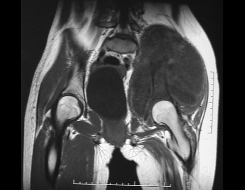 Figura 10: RM coronal, com baixo sinal em T1, com grande tumor extracortical, comprometendo as tábuas internas e externa do ilíaco direito.