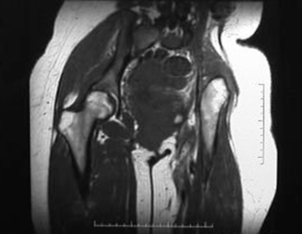 Figura 58: RM coronal T1, após dois anos da cirurgia, sem sinais de recidiva.