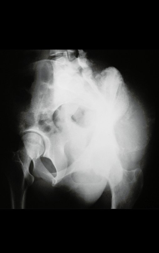 Figura 3: Radiografia em alar, grande tumor extracortical, intra e extrapélvico.