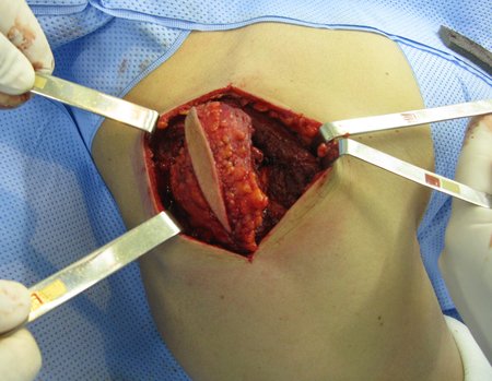 Figura 17: Dissecção nos planos profundos com margem circunferencial da lesão e hemostasia.