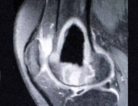 Figura 7: RM, sagital com contraste, demarcando a permanência de tumor e o extravasamento da lesão, em 22/fev./1999.