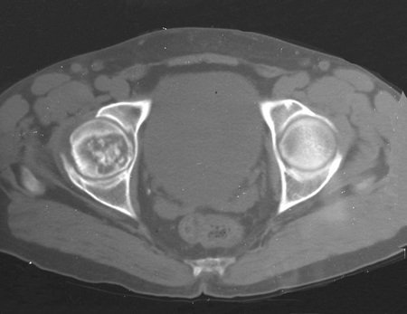 Figura 2: Tomografia com lesão de rarefação óssea na cabeça femoral direito, erosão da cortical interna (em saca bocado) e focos de calcificação. Lesão agressiva localmente, ativa, destruindo a estrutura óssea.