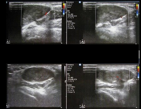 Figura 3: Ultrassonografia realizada três meses antes da nossa consulta.