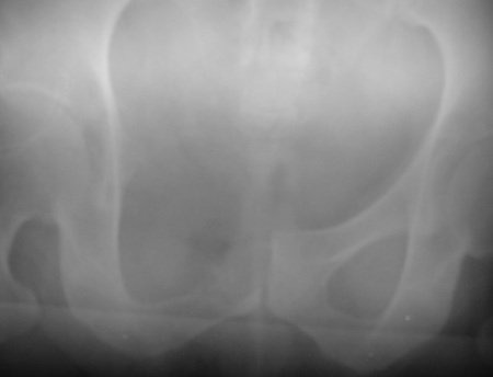 Figura 9: Radiografia da bacia, após a ressecção do ramo íleo púbico direito, com parte da parede do acetábulo.