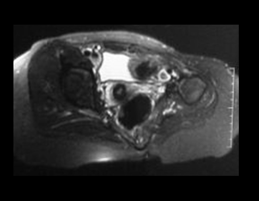 Figura 61: RM axial T2 Stir, após dois anos da cirurgia, bom aspecto local.