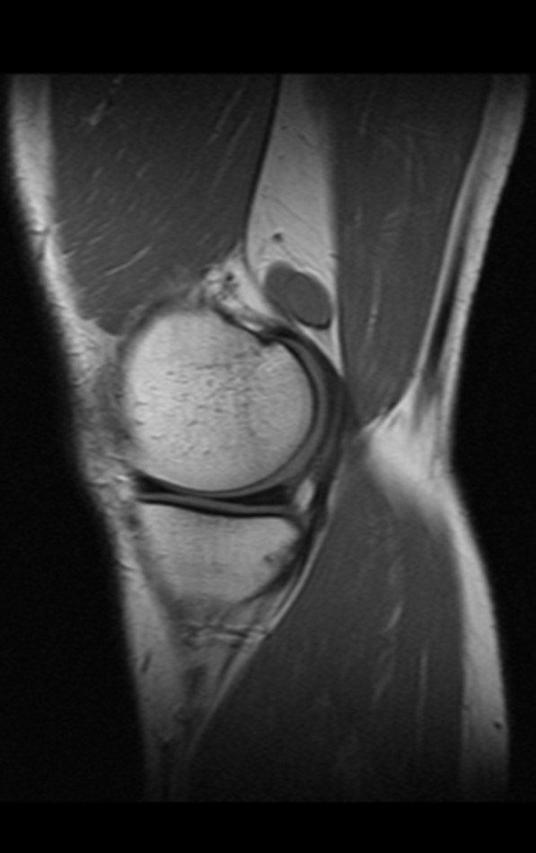 Figura 4: Ressonância magnética realizada um ano antes da queixa atual. Imagem sagital, ponderada em T1, evidenciando lesão de baixo sinal na região posterior do joelho direito.