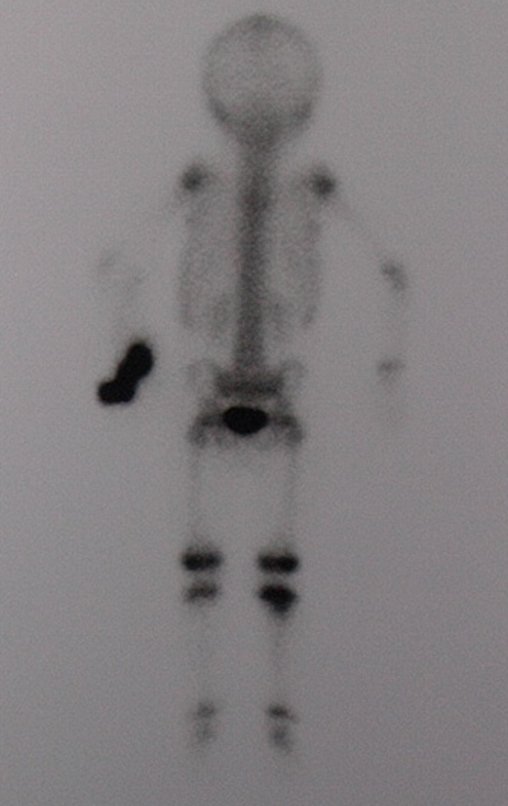 Figura 4: Cintilografia, vista posterir, evidenciando a captação na região proximal da tibia direita.