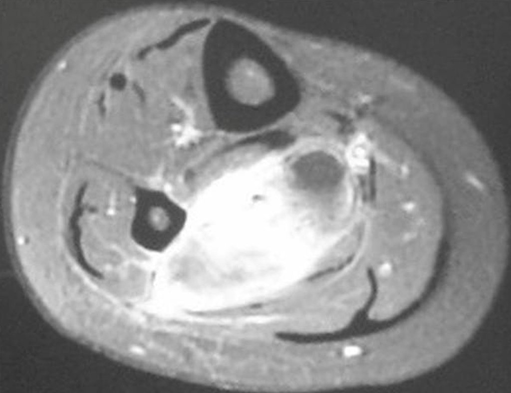 Figura 42: Ressonância magnética axial em T1, corte mais distal.