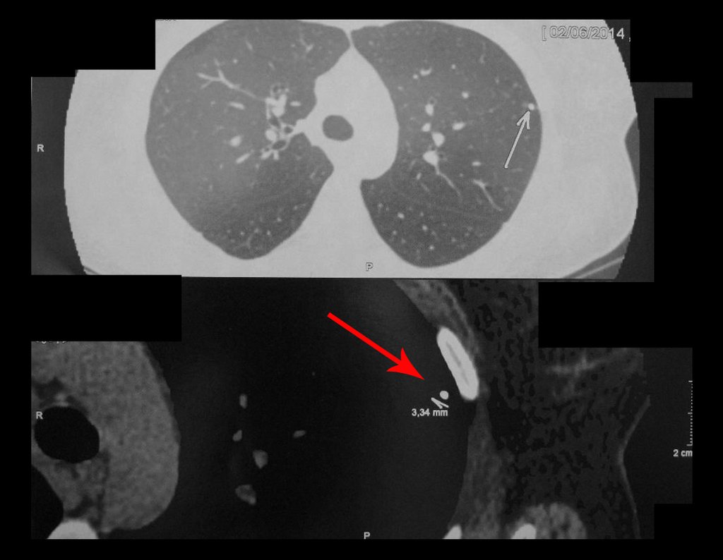 Figura 55: No estudo desta tomografia de tórax evidencia-se o pequeno nódulo calcificado, "cicatriz" do complexo primário da tuberculose.