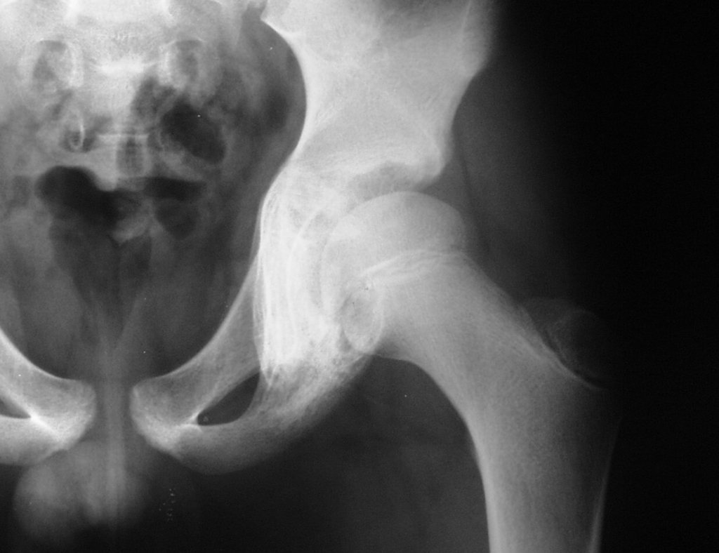 Figura 15: Radiografia focalizada na pelve, evidencia mineralização do ísquio, boa resposta local à quimioterapia.