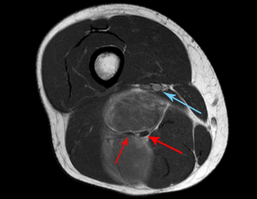 Figura 02: Seta vermelha mostra a divisão do nervo ciativo e a seta em azul o feixe femoral vásculonervoso.